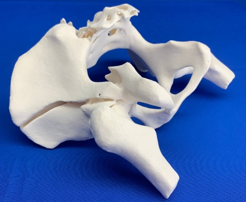 Full Scale 3D Printed Litigation Model: Injured Hips/Pelvis. Broken Hip Bone & the Separation of the Pelvic Bone.