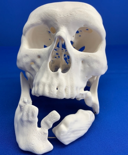 Full Scale 3D Printed Litigation Model: Skull with Broken Jaw & Dislodged Teeth