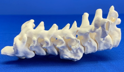 Full Scale 3D Printed Litigation Model: Injured Vertebrae